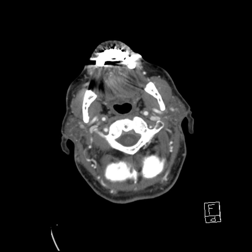 Acute ICA ischemic penumbra due to high-grade CCA stenosis (CT perfusion) (Radiopaedia 72038-82530 Axial C+ arterial phase 30).jpg