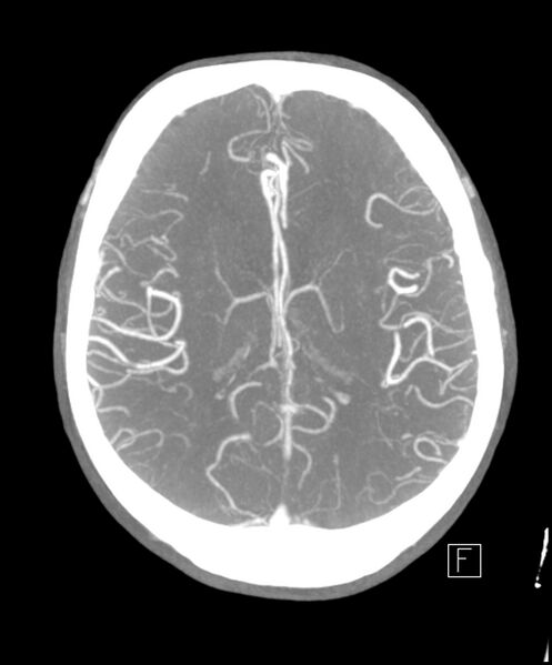 File:Acute P1 occlusion with PCA ischemia penumbra (CT perfusion) (Radiopaedia 72084-82587 Axial C+ arterial thick MIP 5).jpg