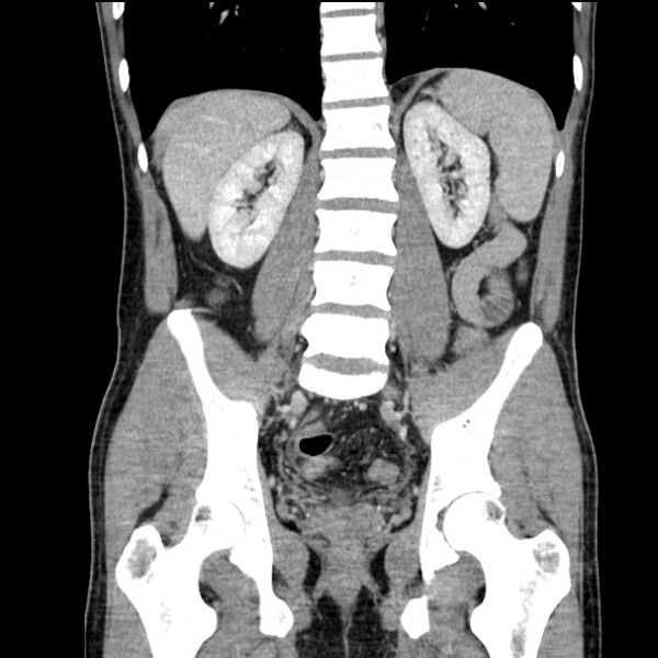 File:Acute appendicitis (Radiopaedia 27049-27227 Coronal C+ portal venous phase 37).jpg