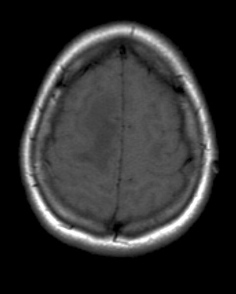 File:Acute disseminated encephalomyelitis (Radiopaedia 2576-6271 Axial T1 1).jpg
