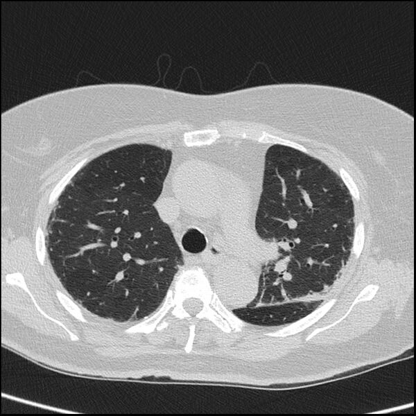 File:Acute interstitial pneumonitis (Radiopaedia 45404-49453 Axial lung window 30).jpg