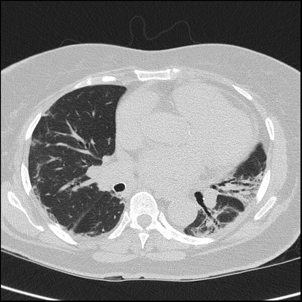 File:Acute interstitial pneumonitis (Radiopaedia 45404-49453 Axial lung window 45).jpg