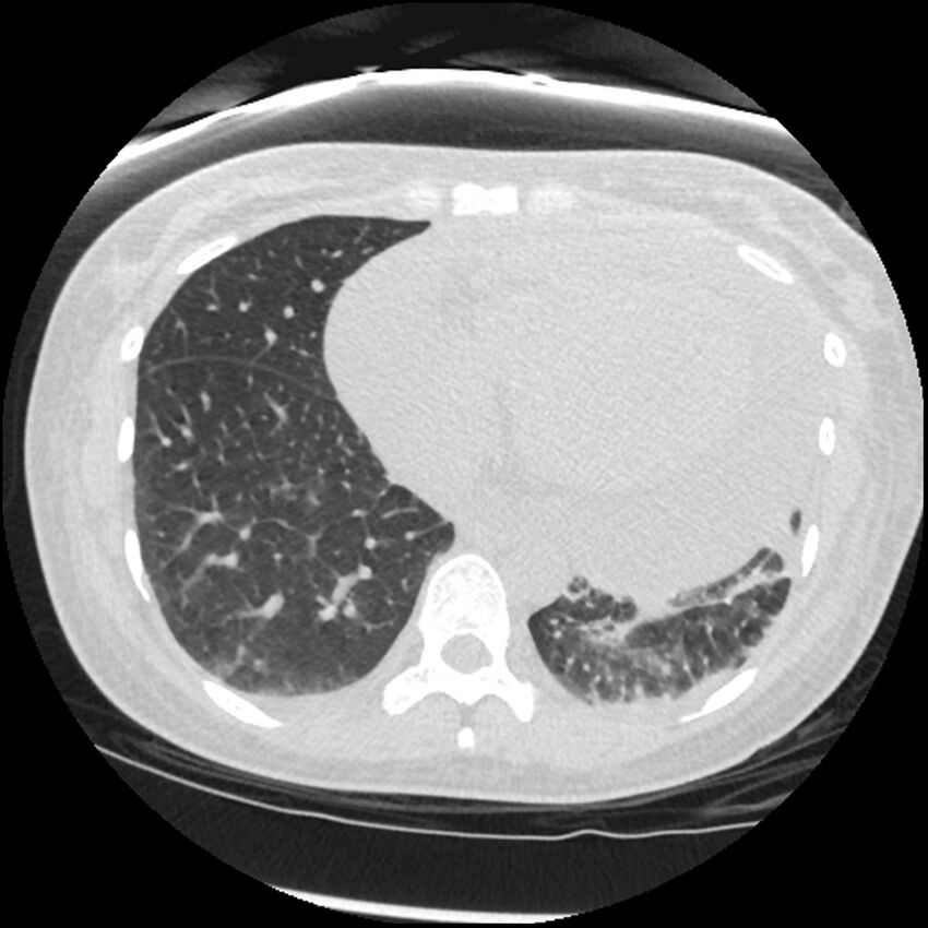 Acute lupus nephritis (Radiopaedia 45832-50107 Axial lung window 69).jpg