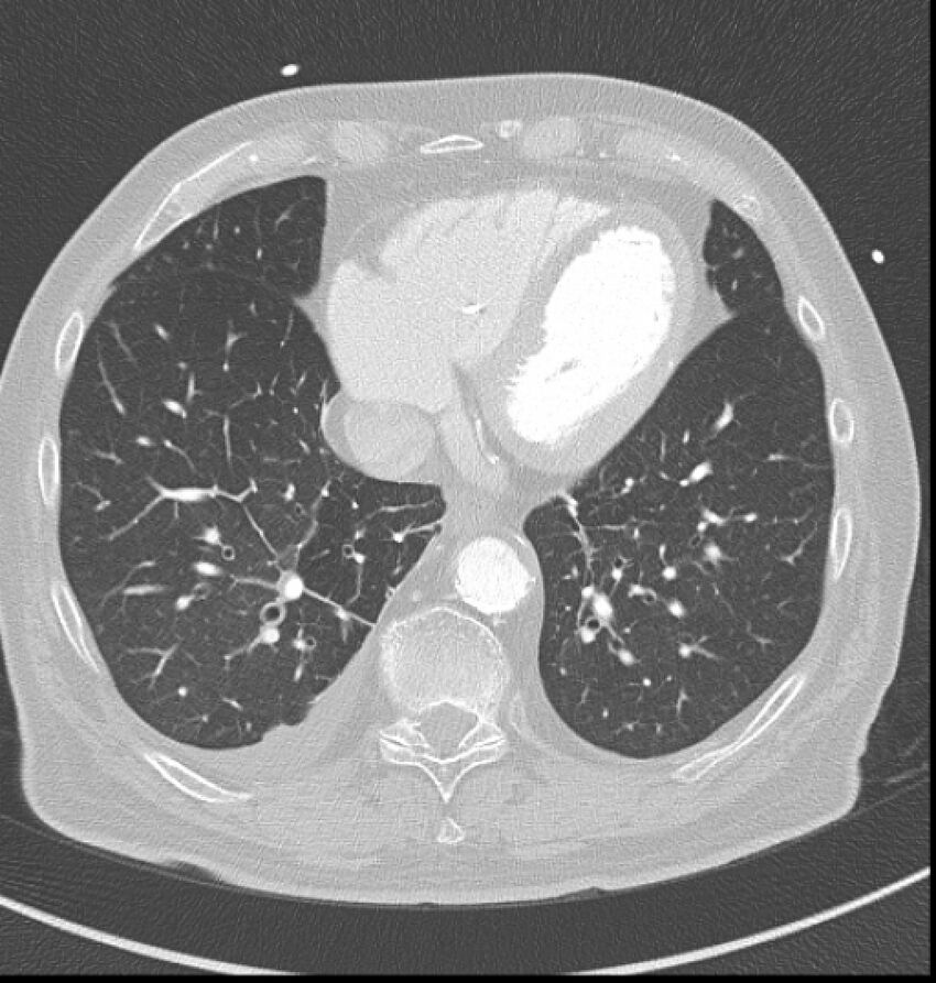 Acute myocardial infarction (Radiopaedia 23413-23481 lung window 52).jpg