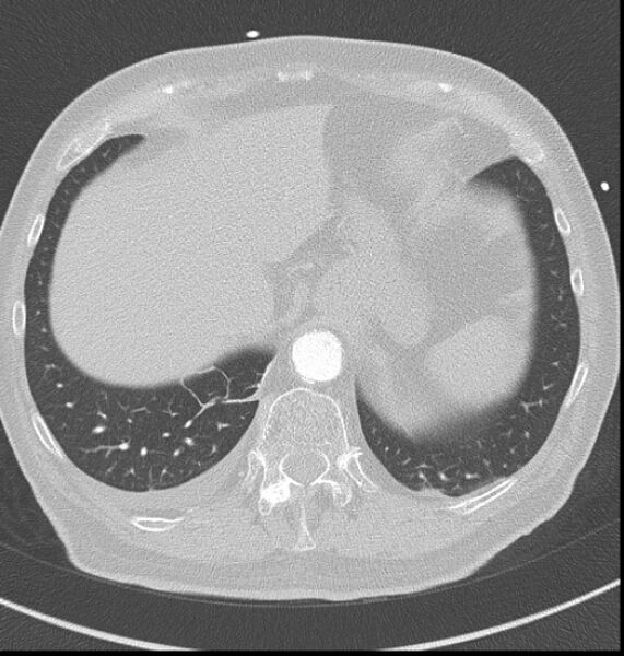 File:Acute myocardial infarction (Radiopaedia 23413-23481 lung window 64).jpg