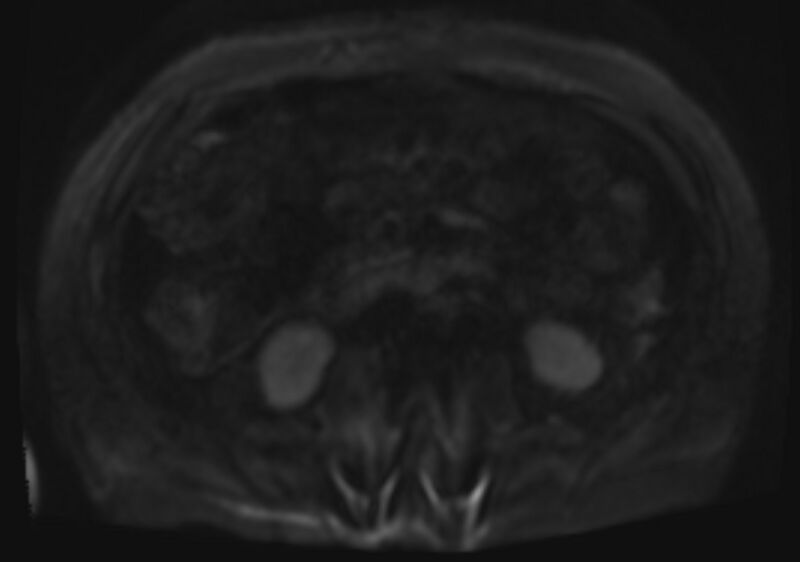 File:Acute portal vein thrombosis (Radiopaedia 73198-83925 Axial DWI 54).jpg