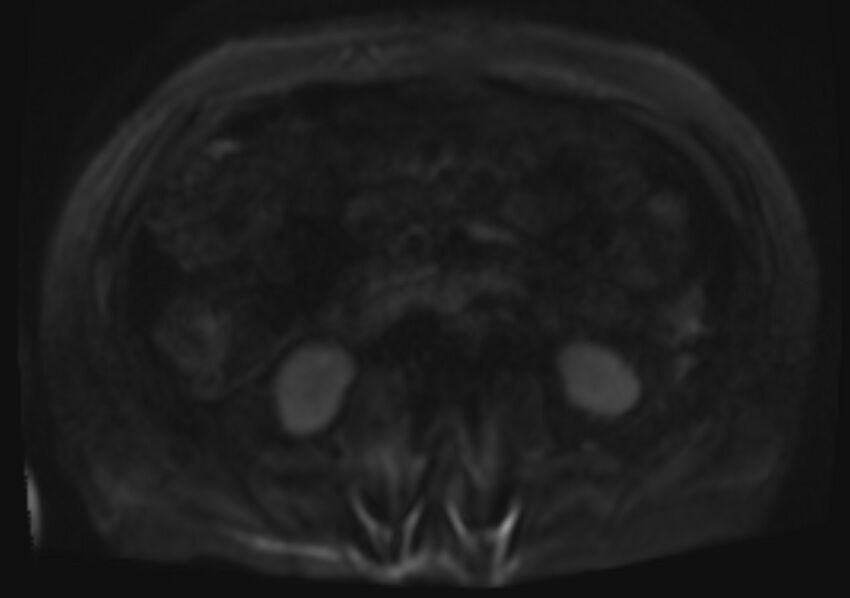 Acute portal vein thrombosis (Radiopaedia 73198-83925 Axial DWI 54).jpg