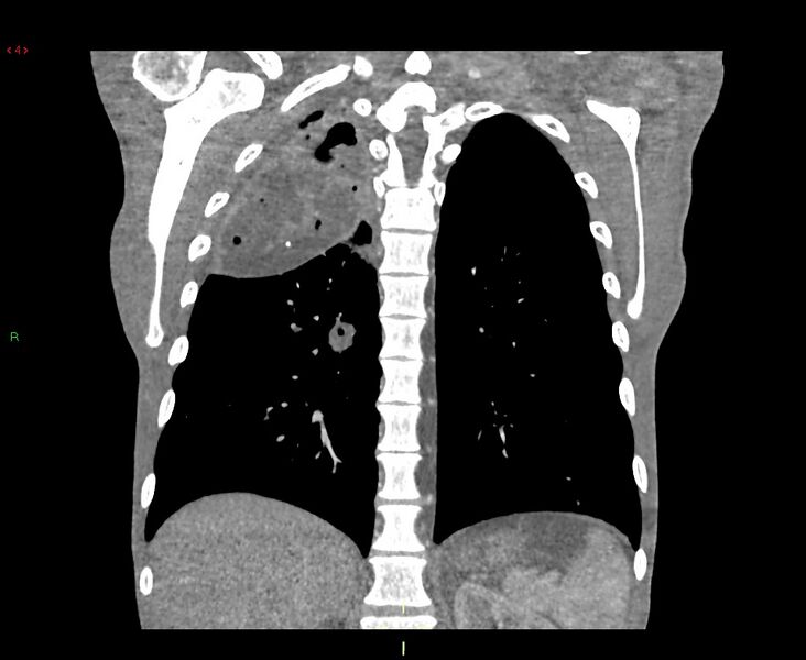 File:Acute right lung abscess (Radiopaedia 34806-36258 Coronal C+ arterial phase 15).jpg