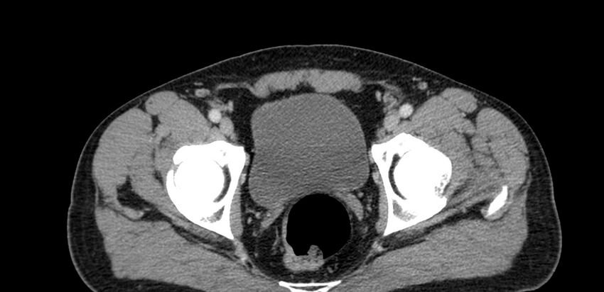 Acute sigmoid colon diverticulitis (Radiopaedia 55507-61976 Axial C+ portal venous phase 115).jpg