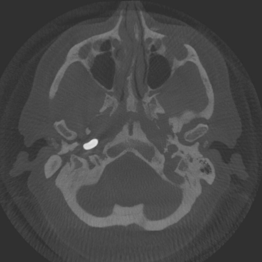 Acute subarachnoid hemorrhage and accessory anterior cerebral artery (Radiopaedia 69231-79010 Axial arterial - MIP 8).jpg