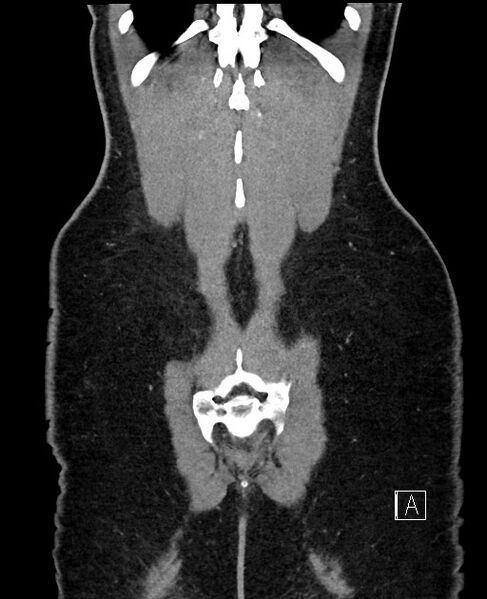 File:Acute uncomplicated appendicitis (Radiopaedia 61374-69304 Coronal C+ portal venous phase 96).jpg