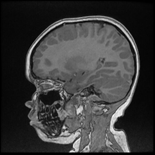 File:Adamantinomatous craniopharyngioma (Radiopaedia 77407-89529 Sagittal T1 C+ 47).jpg