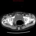 Adenocarcinoma of the colon (Radiopaedia 8191-9039 Axial liver window 72).jpg