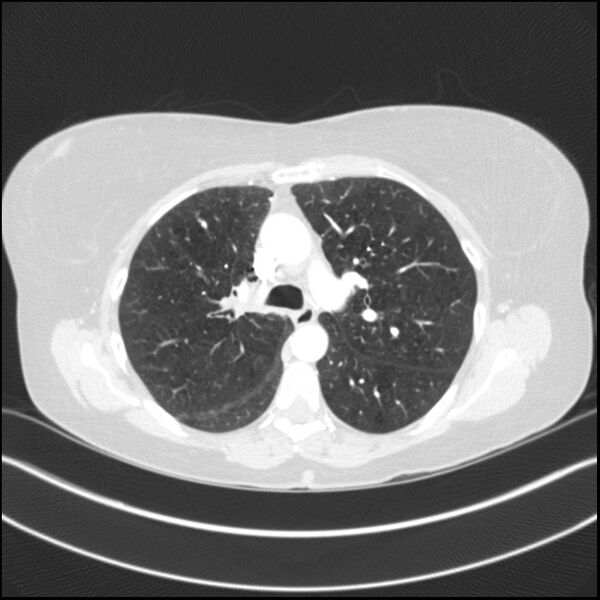 File:Adenocarcinoma of the lung (Radiopaedia 44205-47803 Axial lung window 37).jpg