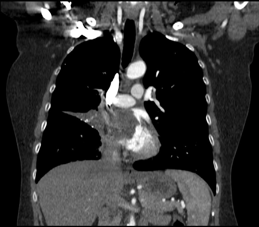 Adenocarcinoma of the lung (Radiopaedia 44205-47803 Coronal C+ portal venous phase 41).jpg