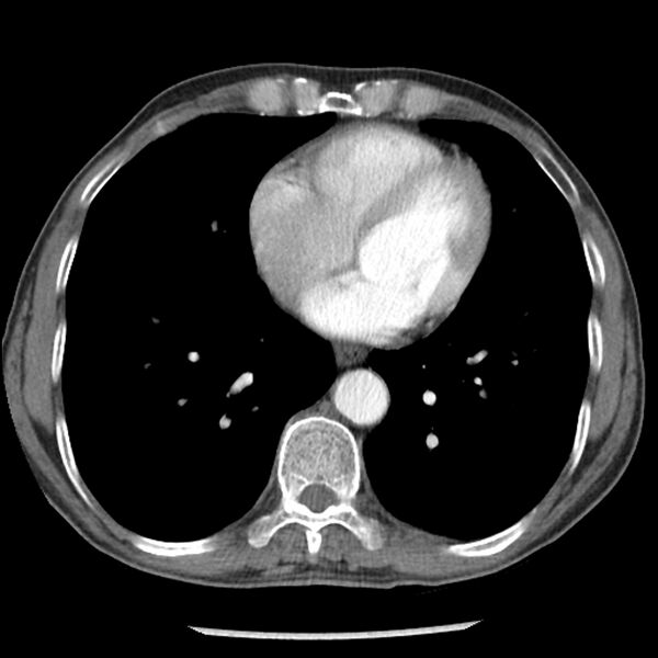 File:Adenocarcinoma of the lung - micropapillary predominant (Radiopaedia 42446-45563 Axial C+ portal venous phase 50).jpg