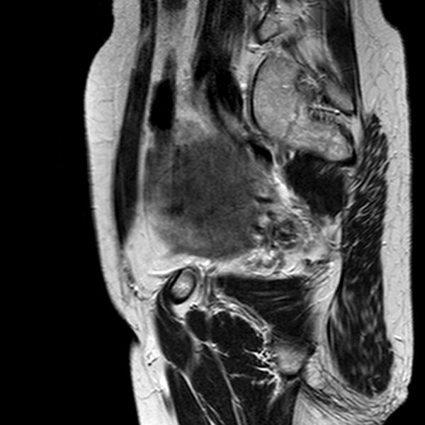 File:Adenomyoma of the uterus (huge) (Radiopaedia 9870-10438 Sagittal T2 1).jpg
