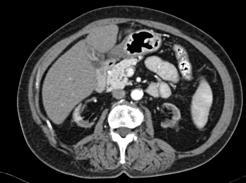 File:Adenomyomatosis of the gallbladder (Radiopaedia 12142-12483 Axial C+ arterial phase 13).jpg