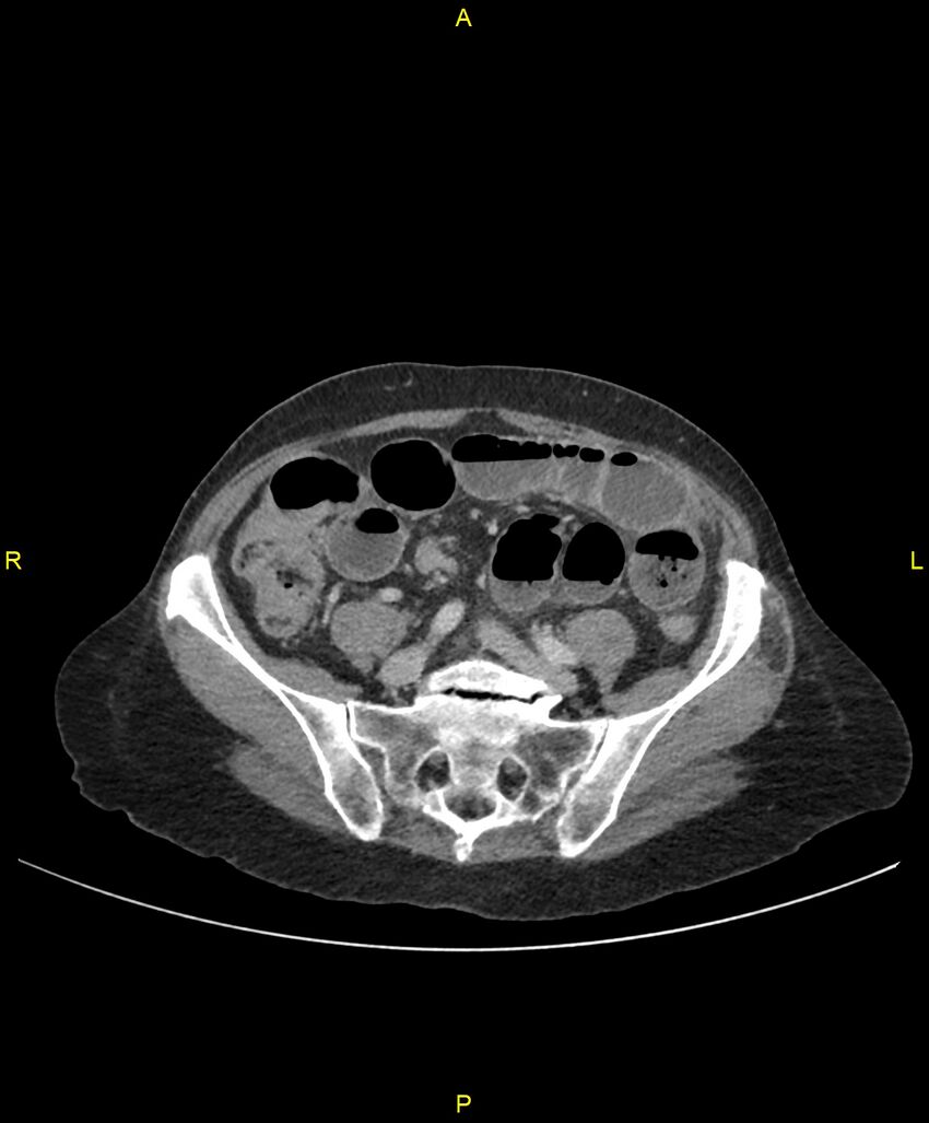 Adhesional small bowel obstruction (Radiopaedia 85402-101024 Axial C+ portal venous phase 199).jpg