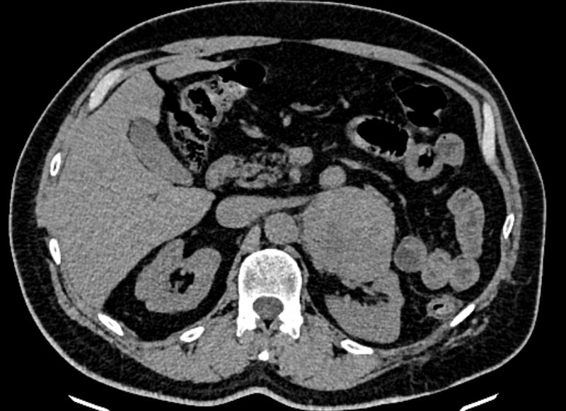File:Adrenal metastases (Radiopaedia 73082-83791 Axial non-contrast 63).jpg