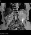 Adrenal myelolipoma (Radiopaedia 6765-7961 Coronal T2 2).jpg