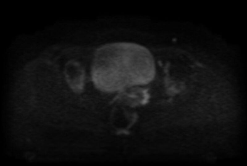 File:Adult granulosa cell tumor of the ovary (Radiopaedia 71581-81950 Axial DWI 17).jpg