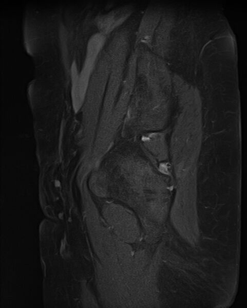 File:Adult granulosa cell tumor of the ovary (Radiopaedia 71581-81950 Sagittal T1 C+ fat sat 21).jpg