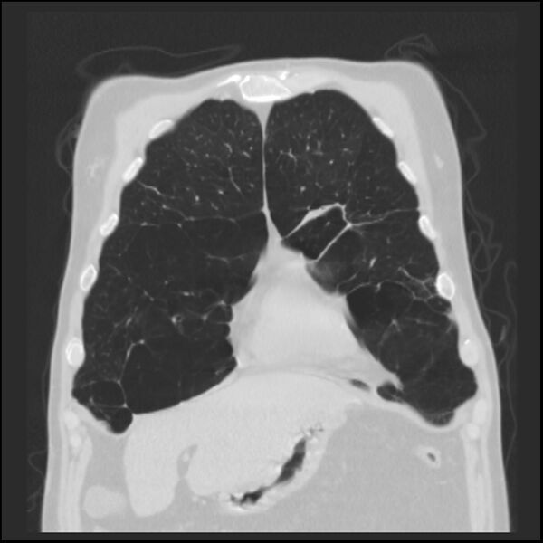 File:Alpha-1-antitrypsin deficiency (Radiopaedia 40993-43722 Coronal lung window 18).jpg