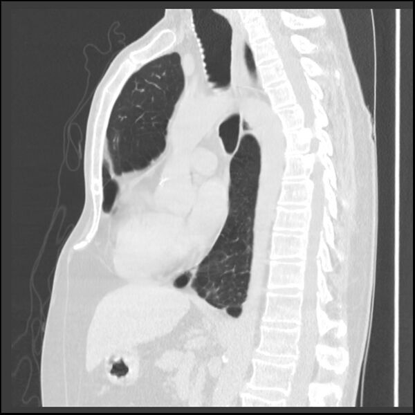 File:Alpha-1-antitrypsin deficiency (Radiopaedia 40993-43722 Sagittal lung window 131).jpg