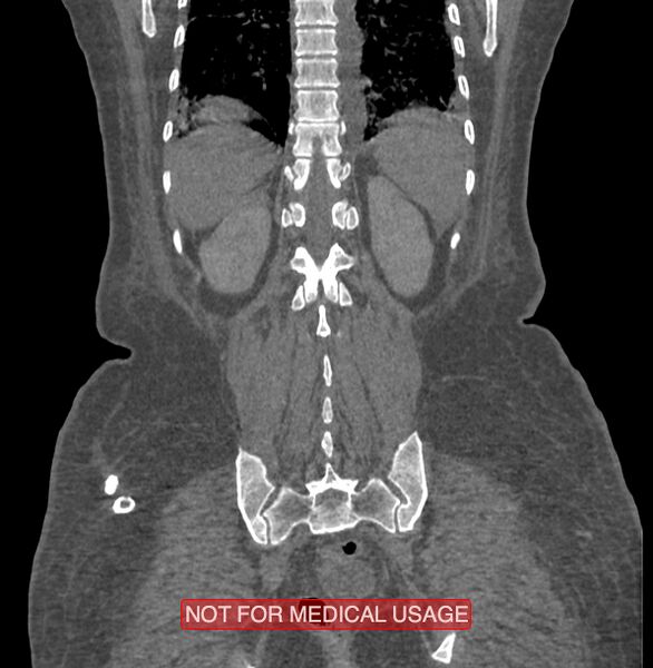 File:Amoebic enterocolitis with liver abscess (Radiopaedia 35100-36609 B 168).jpg