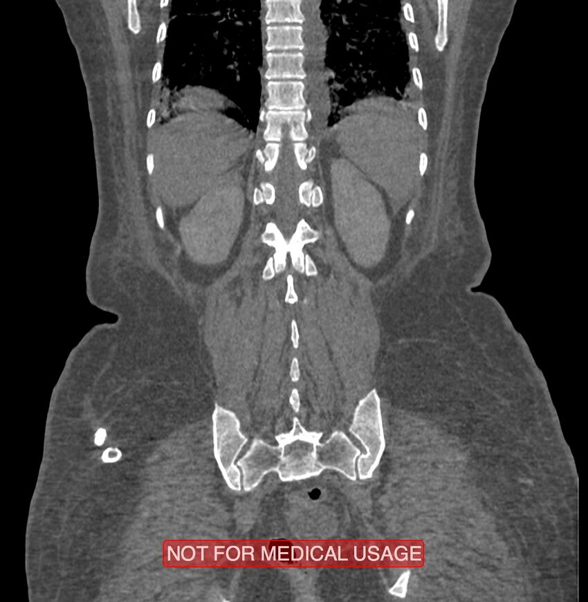 Amoebic enterocolitis with liver abscess (Radiopaedia 35100-36609 B 168).jpg