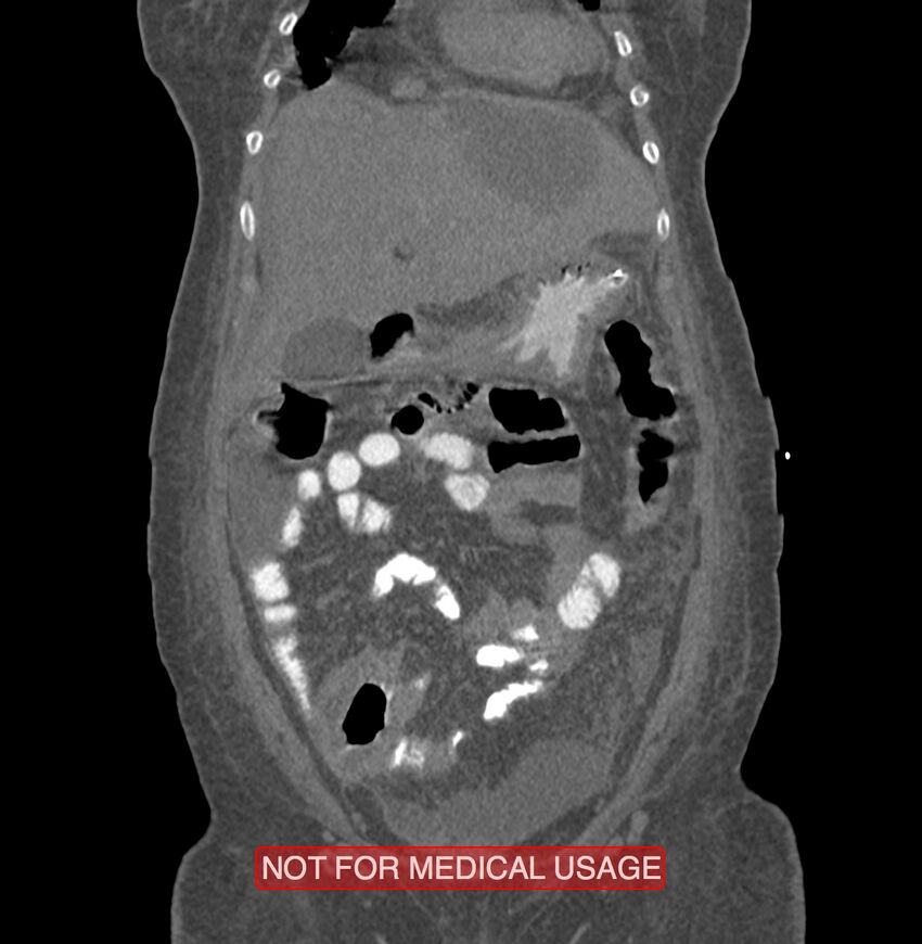 Amoebic enterocolitis with liver abscess (Radiopaedia 35100-36609 B 40).jpg