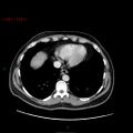 Ampullary carcinoma (Radiopaedia 56396-63056 C 10).jpg