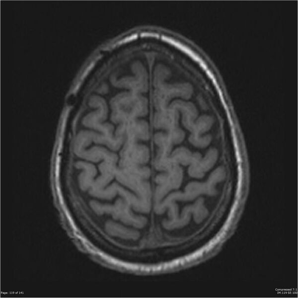 File:Anaplastic meningioma with recurrence (Radiopaedia 34452-35788 Axial T1 117).jpg