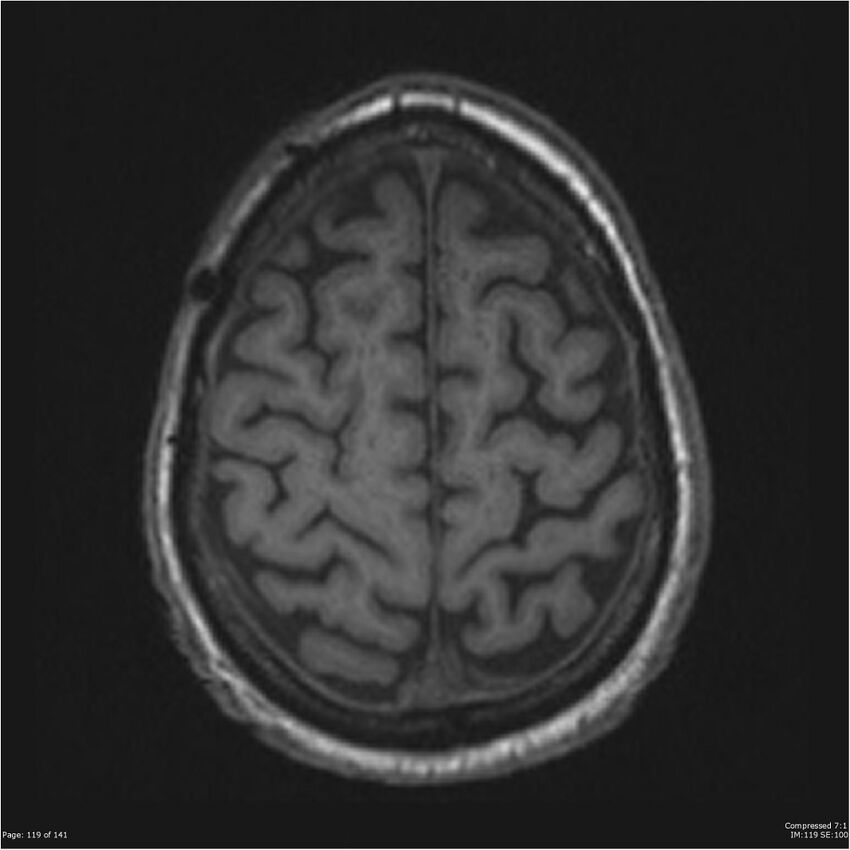 Anaplastic meningioma with recurrence (Radiopaedia 34452-35788 Axial T1 117).jpg