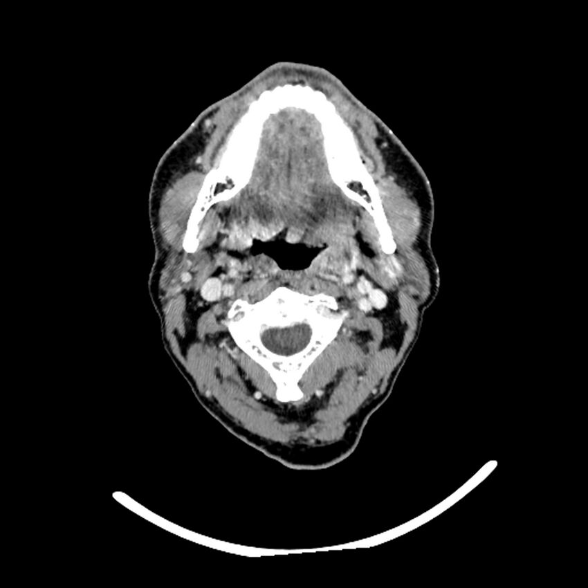 Anaplastic thyroid carcinoma (Radiopaedia 79087-92034 B 91).jpg