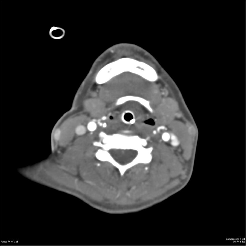 Aneurysmal subarachnoid hemorrhage and Moya Moya disease (Radiopaedia 34306-35593 Axial CT COW 74).jpg