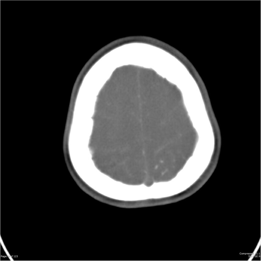 Aneurysmal subarachnoid hemorrhage and Moya Moya disease (Radiopaedia 34306-35593 Axial CT COW 9).jpg