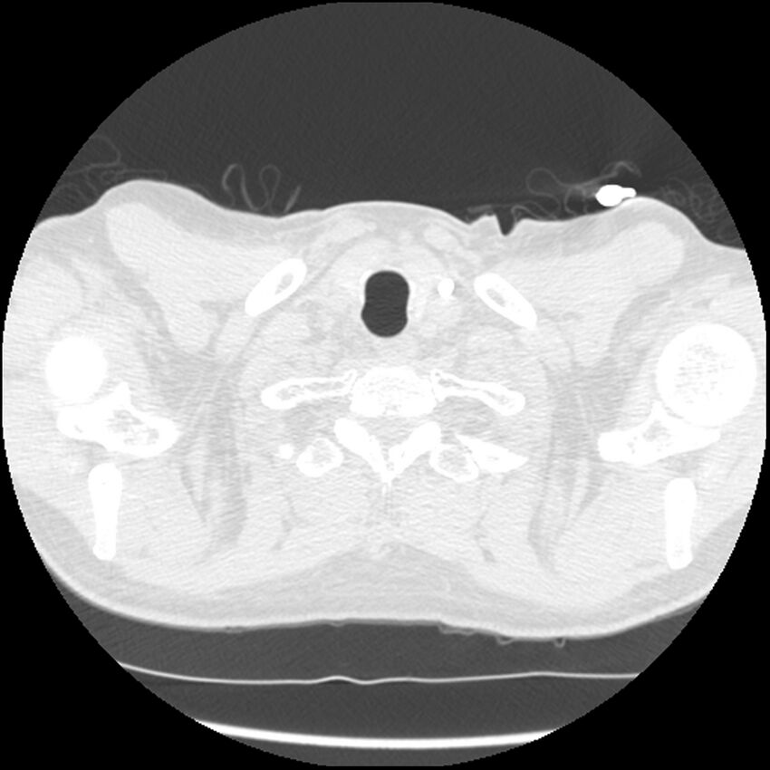 Angioinvasive aspergillosis (Radiopaedia 43957-47466 C 1).jpg