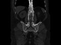 Ankylosing spondylitis (Radiopaedia 44609-48357 Coronal bone window 69).jpg