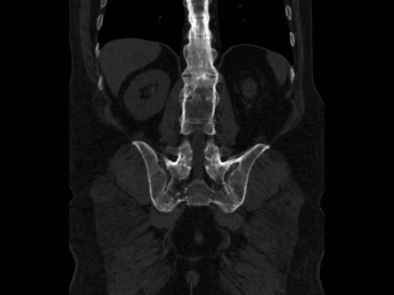 File:Ankylosing spondylitis (Radiopaedia 44609-48357 Coronal bone window 69).jpg