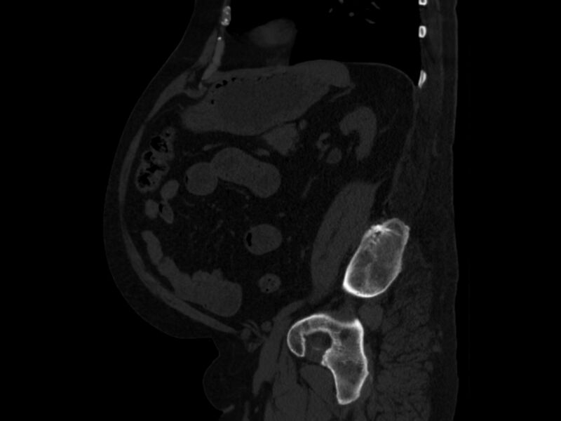 File:Ankylosing spondylitis (Radiopaedia 44609-48357 Sagittal bone window 76).jpg