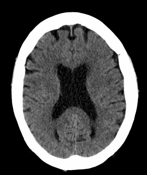 File:Anomalous intracranial venous drainage (Radiopaedia 28161-28418 Axial 26).png
