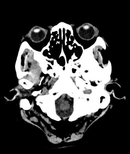 File:Anomalous intracranial venous drainage (Radiopaedia 28161-28418 Axial 59).png
