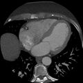 Anomalous origin of left circumflex artery from right coronary sinus (Radiopaedia 72563-83117 A 24).jpg