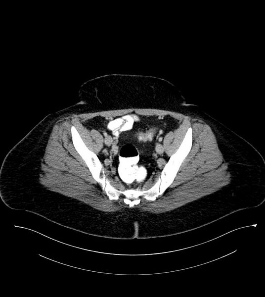 File:Anterior abdominal wall CSF pseudocyst (CSFoma) (Radiopaedia 79453-92571 A 76).jpg