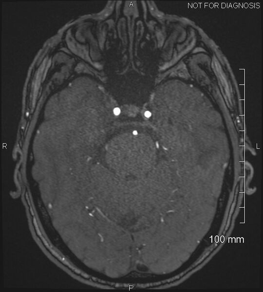 File:Anterior cerebral artery aneurysm (Radiopaedia 80683-94127 Axial MRA 76).jpg