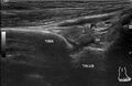 Anterior talofibular ligament bony avulsion from fibula (Radiopaedia 83432).jpg