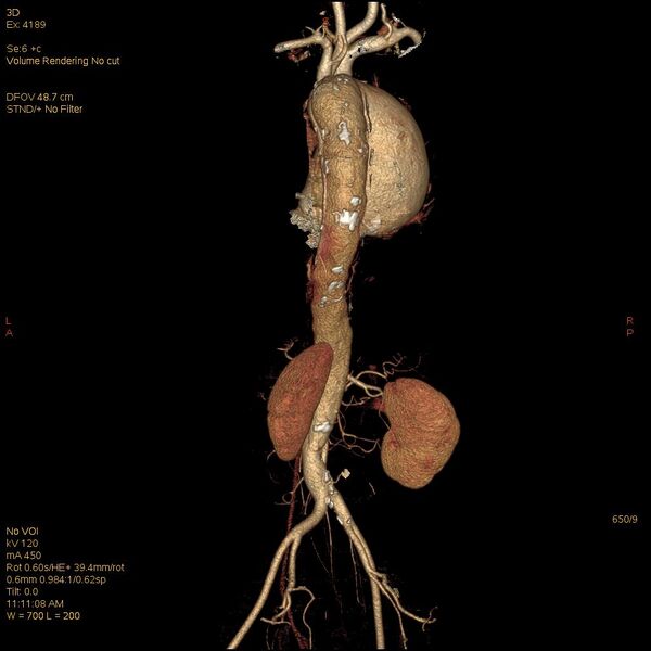 File:Aortic dissection (Radiopaedia 25350-25604 E 9).jpg