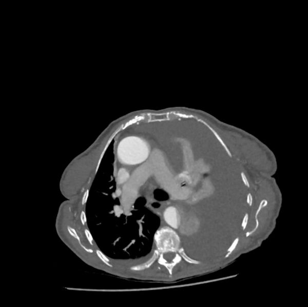 File:Aortic dissection (Radiopaedia 68763-78691 A 21).jpeg